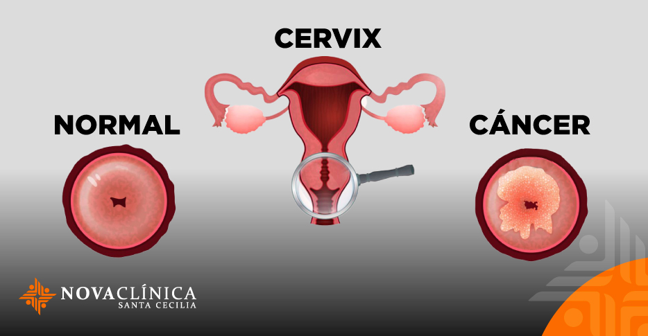 Prevención Integral del Cáncer de Cuello Uterino